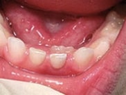 Adult Teeth Coming in Behind Baby Teeth